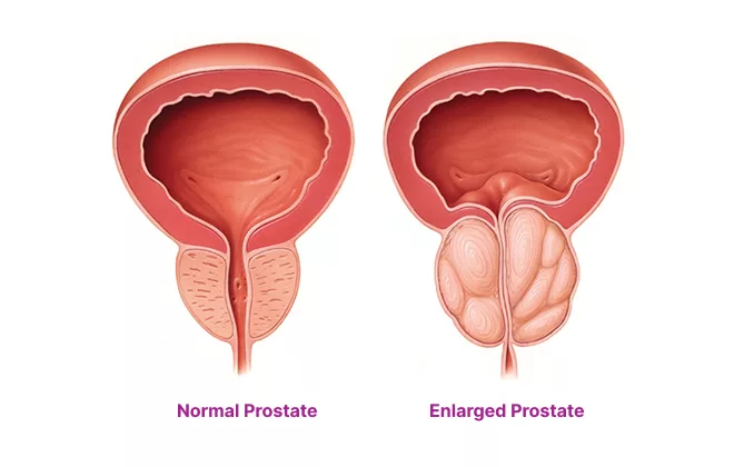 Аденома простати: симптоми, лікування та профілактика