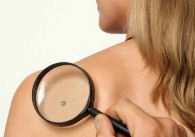 Як можна видалити новоутворення (родимки, папіломи, меланоми)?