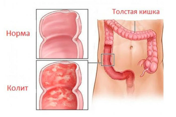 Коліт - діагностика і лікування Коліт - діагностика і лікування