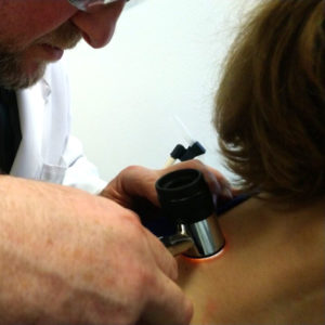 Видалення новоутворень шкіри радіохвильовим методом: усе, що варто знати