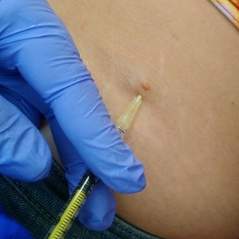 Видалення новоутворень шкіри радіохвильовим методом: усе, що варто знати